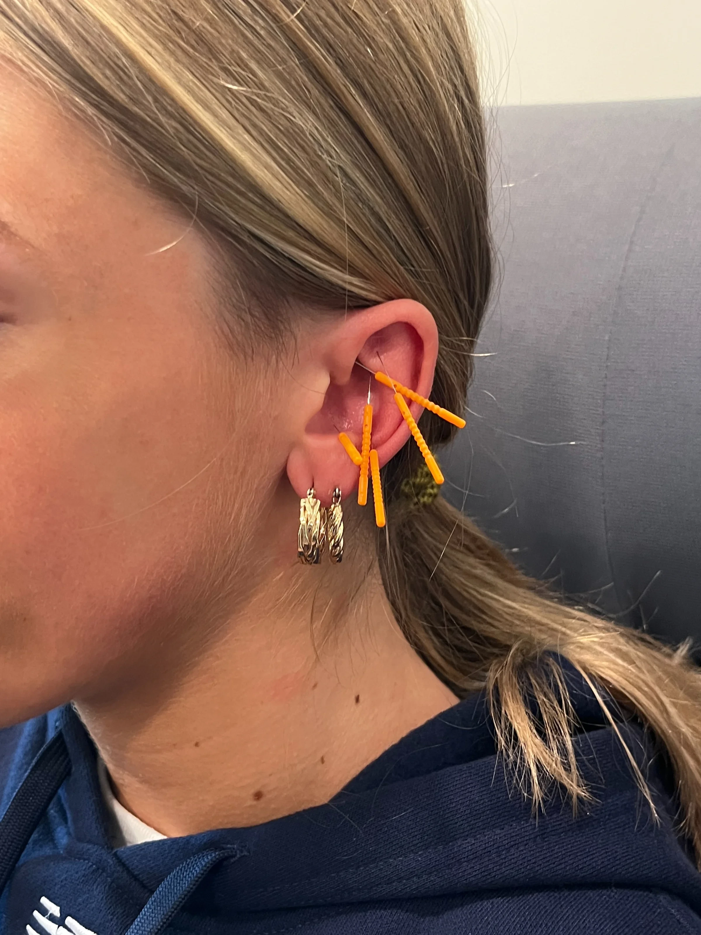 Auricular Acupuncture